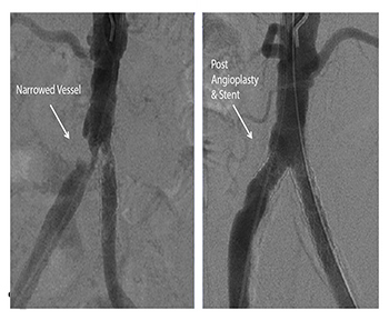 Claudication – LONDON & SURREY VEINS